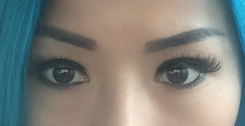 After Asian Double Eyelid Crease Formation Eyelift Blepharoplasty for The Single Eyelid Fold using the Orbicularis Levator Fixation Technique After Asian Double Eyelid Crease Formation Eyelift Blepharoplasty for The Single Eyelid Fold using the Orbicularis Levator Fixation Technique