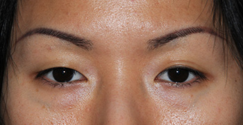 Before Asian Double Eyelid Crease Formation Eyelift Blepharoplasty for The Single Eyelid Fold using the Orbicularis Levator Fixation Technique Before Asian Double Eyelid Crease Formation Eyelift Blepharoplasty for The Single Eyelid Fold using the Orbicularis Levator Fixation Technique