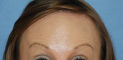 Botox® Dysport® for Forehead Wrinkles After Botox® Dysport® for Forehead Wrinkles After