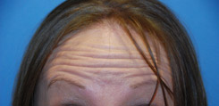 Botox® Dysport® for Forehead Wrinkles Before Botox® Dysport® for Forehead Wrinkles Before
