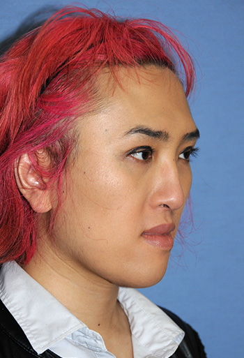 Chin Reduction | Shaping for a Single Eyelid Crease and Large, Protuberant Masculine Chin Chin Reduction | Shaping for a Single Eyelid Crease and Large, Protuberant Masculine Chin