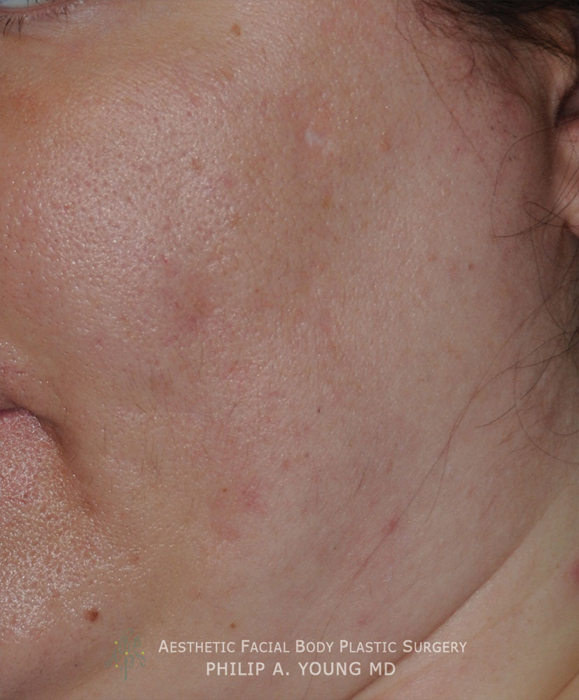 acne scar treatment for Rolling Scars, Box Car Scars Before Left Oblique acne scar treatment for Rolling Scars, Box Car Scars Before Left Oblique