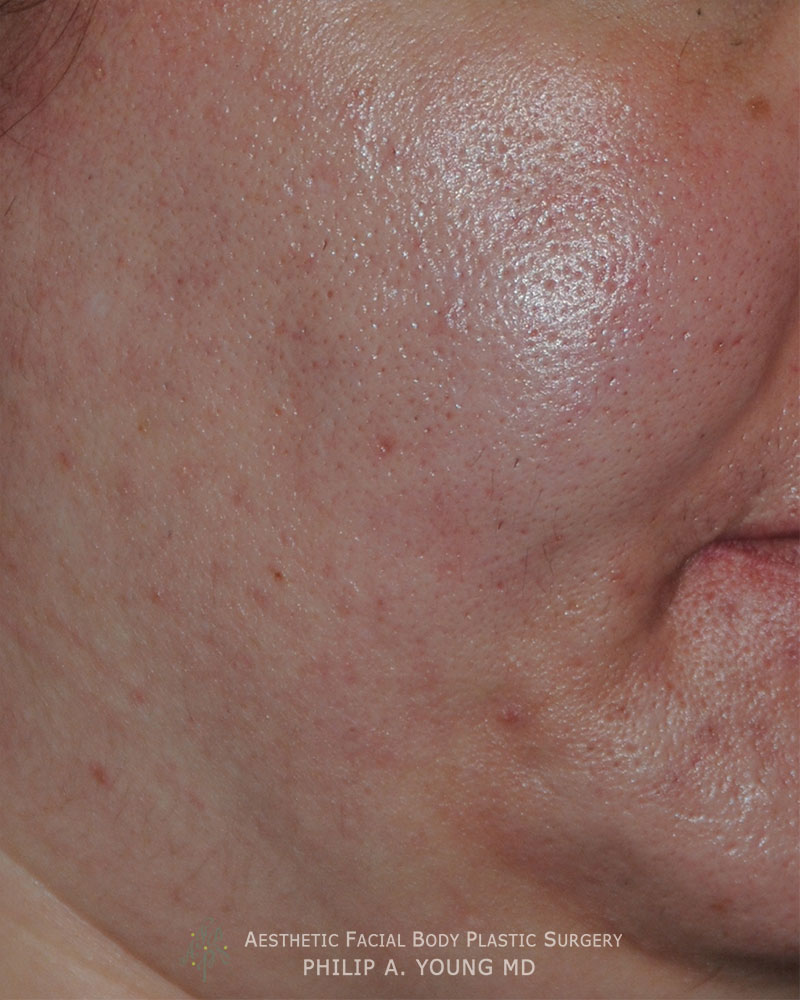 Acne Scar Treatment Oblique View for Rolling Scars, Box Car Scars After Acne Scar Treatment Oblique View for Rolling Scars, Box Car Scars After