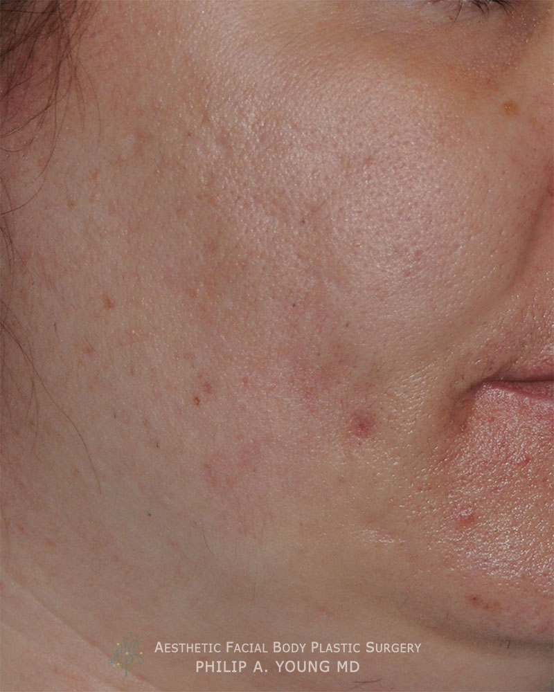 Acne Scar Treatment Oblique View for Rolling Scars, Box Car Scars Before Acne Scar Treatment Oblique View for Rolling Scars, Box Car Scars Before