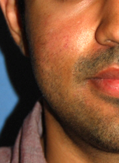 acne scar treatment after