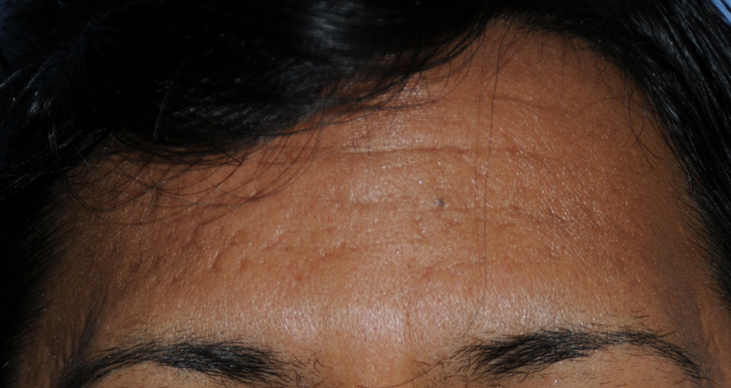 Dark Skin Toned Male Patient Acne Scar Vitalizer Treatment Before Image for Severe Scarring in the Forehead Dark Skin Toned Male Patient Acne Scar Vitalizer Treatment Before Image for Severe Scarring in the Forehead