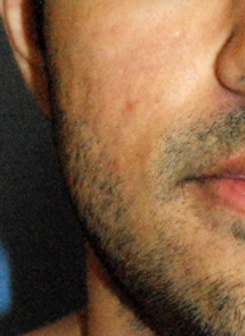 acne scar treatment before