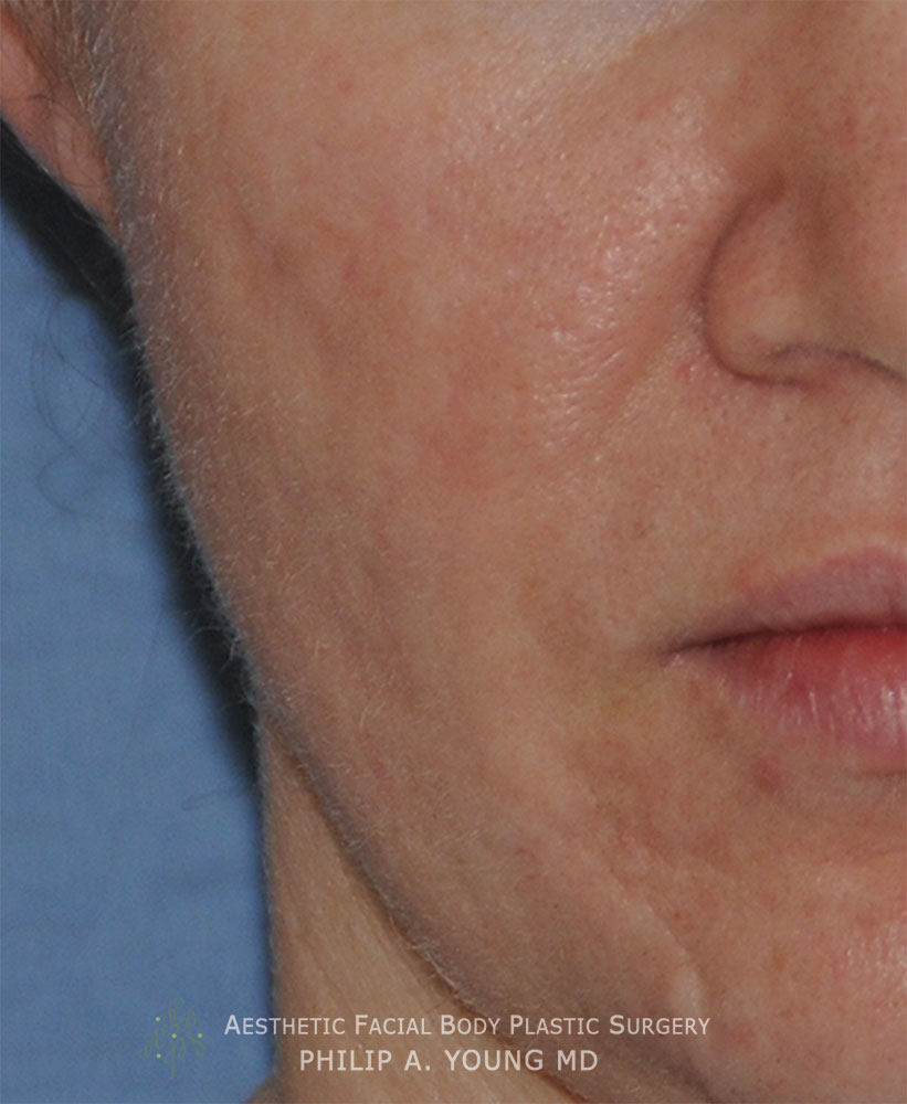 Caucasian Acne Scar Vitalizer Treatment Before Afters of the Right Cheek Before Caucasian Acne Scar Vitalizer Treatment Before Afters of the Right Cheek Before