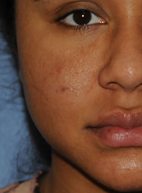 Acne Scar Vitalizer African American 6 months After Treatment Right Front Close Up