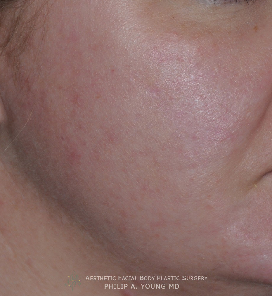 Caucasian Acne Scar Vitalizer Treatment Before Afters of the Right Cheek Chin Oblique After Caucasian Acne Scar Vitalizer Treatment Before Afters of the Right Cheek Chin Oblique After