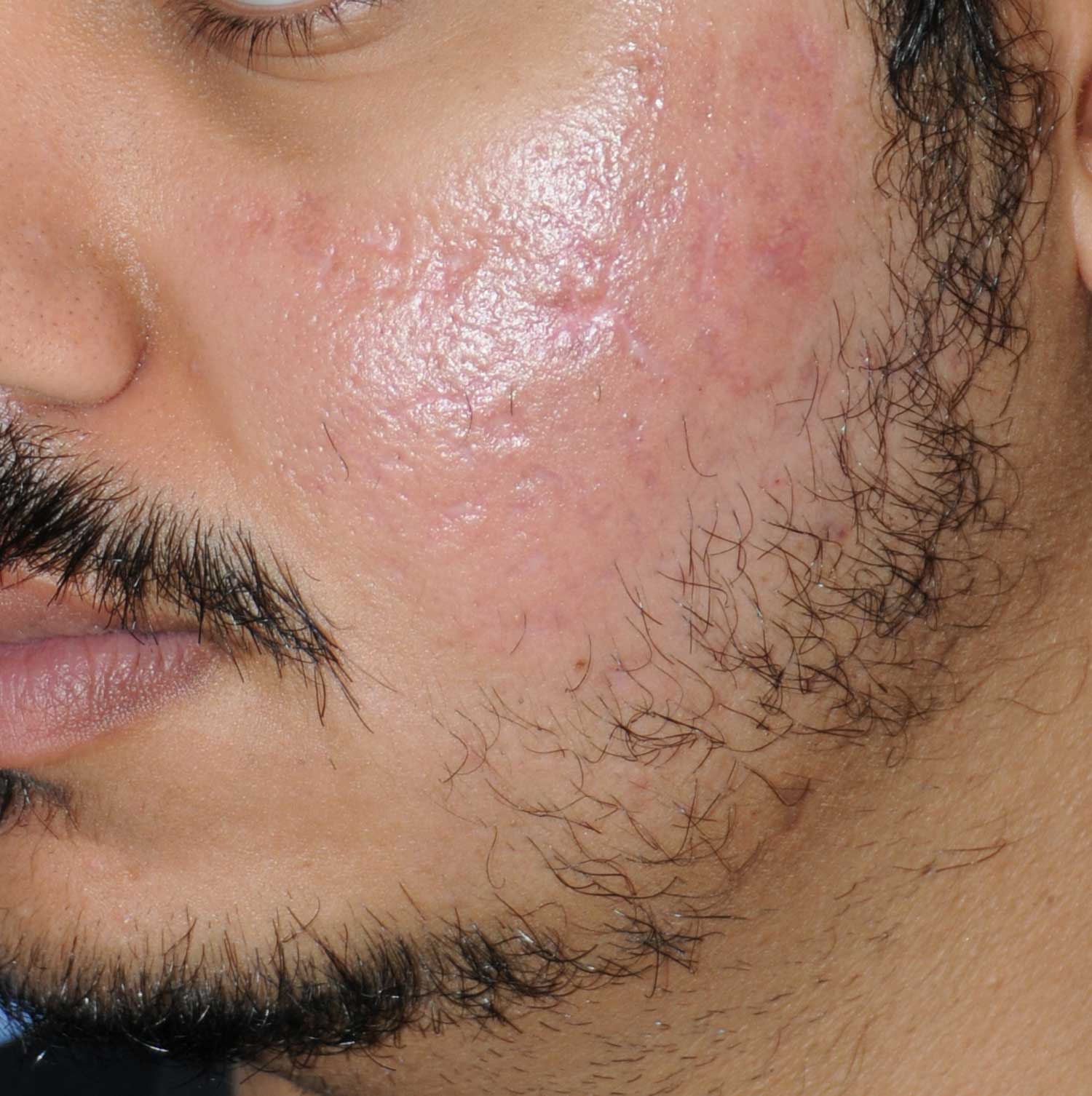 Moderately Dark Skin Toned Patient Acne Scar Vitalizer Treatment After Images of the Left Cheeks and Temples Moderately Dark Skin Toned Patient Acne Scar Vitalizer Treatment After Images of the Left Cheeks and Temples