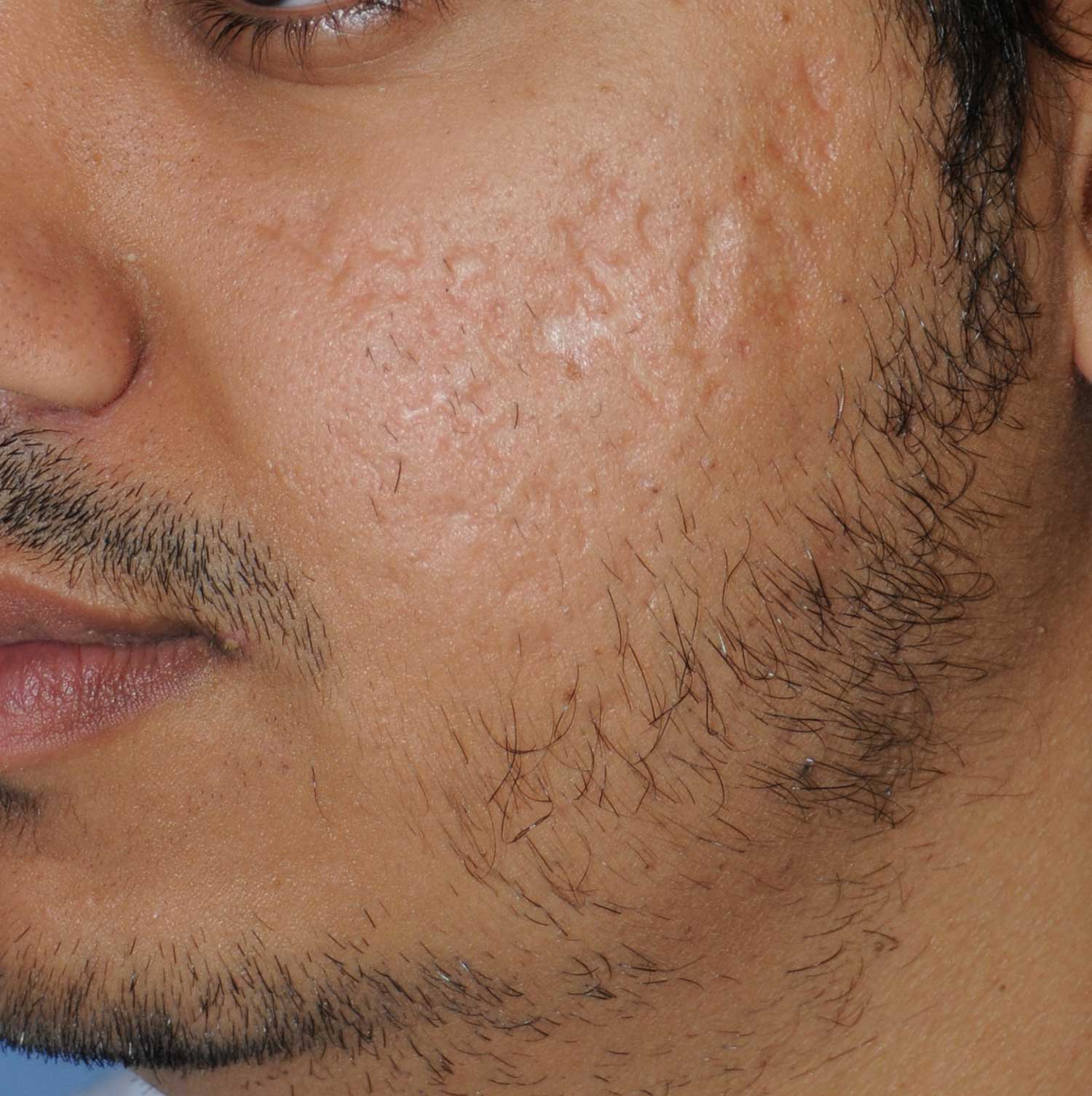 Moderately Dark Skin Toned Patient Acne Scar Vitalizer Treatment Before Images of the Left Cheeks and Temples Moderately Dark Skin Toned Patient Acne Scar Vitalizer Treatment Before Images of the Left Cheeks and Temples