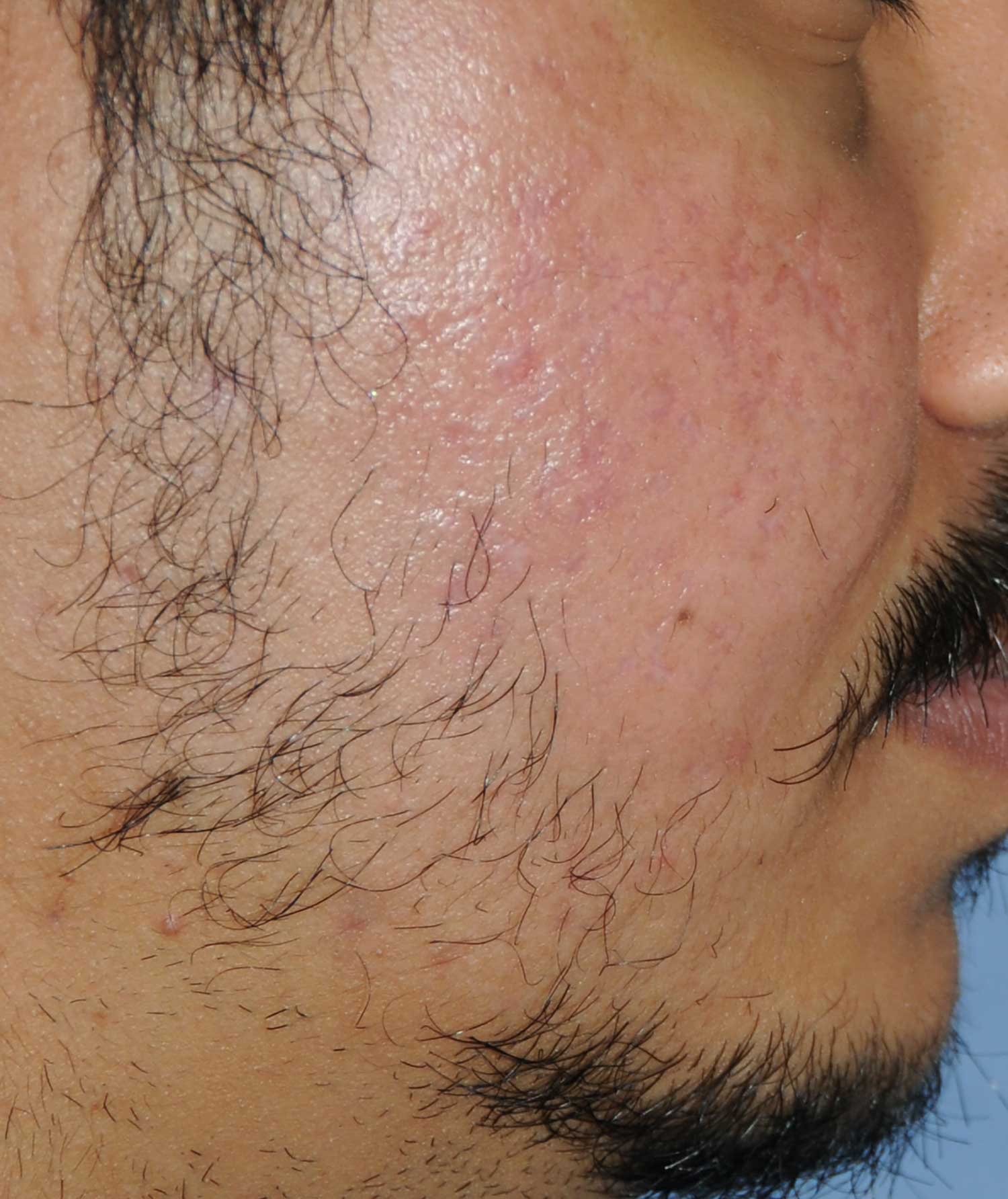 >Moderately Dark Skin Toned Patient Acne Scar Vitalizer Treatment Before Images of the Right Cheeks and Temples Profile View >Moderately Dark Skin Toned Patient Acne Scar Vitalizer Treatment Before Images of the Right Cheeks and Temples Profile View