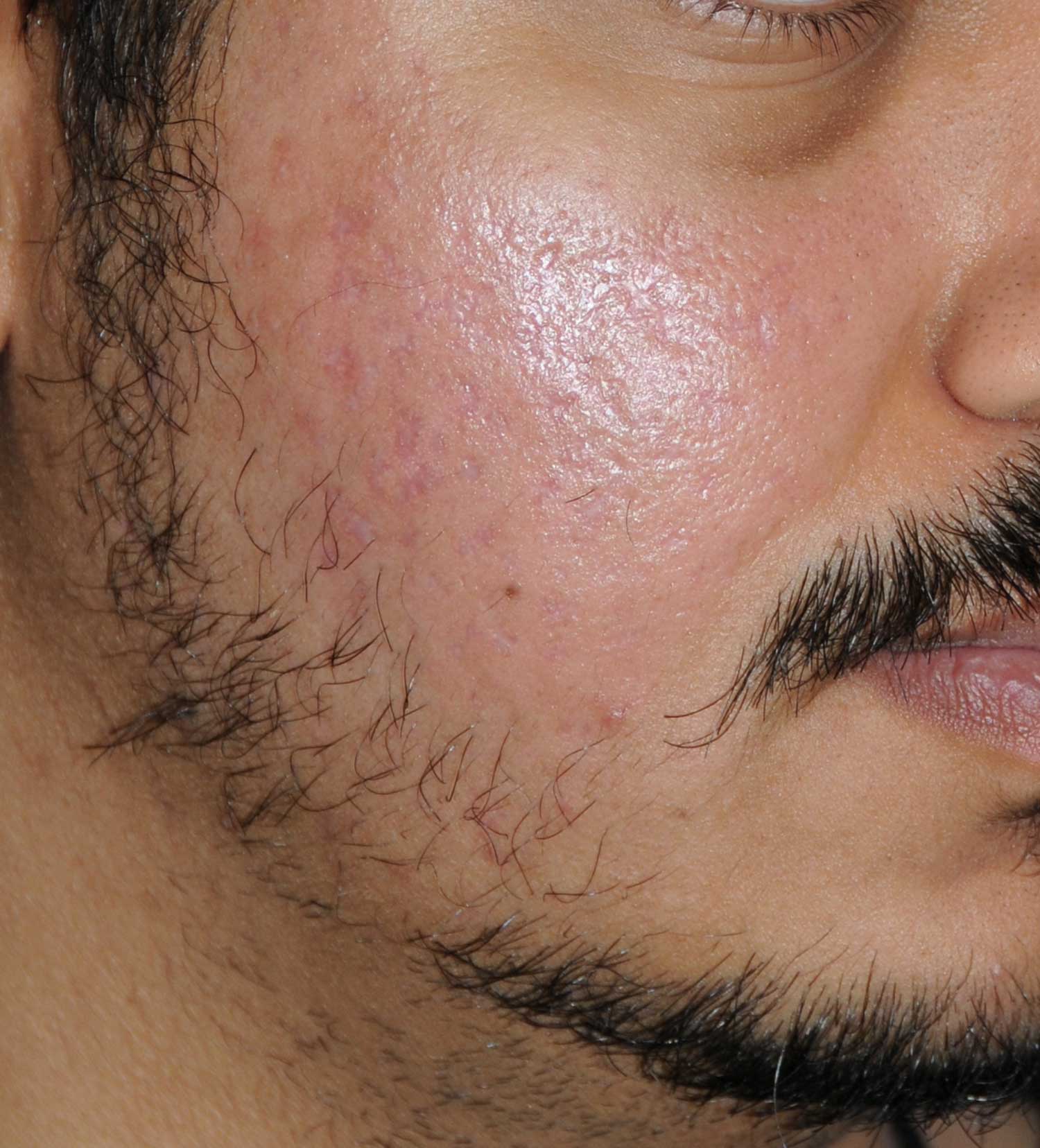 >Moderately Dark Skin Toned Patient Acne Scar Vitalizer Treatment Before Images of the Right Cheeks and Temples >Moderately Dark Skin Toned Patient Acne Scar Vitalizer Treatment Before Images of the Right Cheeks and Temples