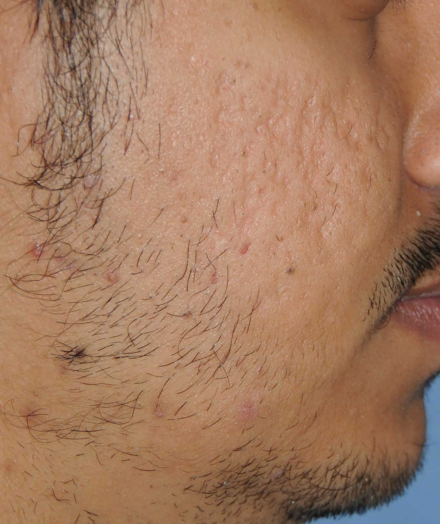 Moderately Dark Skin Toned Patient Acne Scar Vitalizer Treatment Before Images of the Right Cheeks and Temples Profile View Moderately Dark Skin Toned Patient Acne Scar Vitalizer Treatment Before Images of the Right Cheeks and Temples Profile View