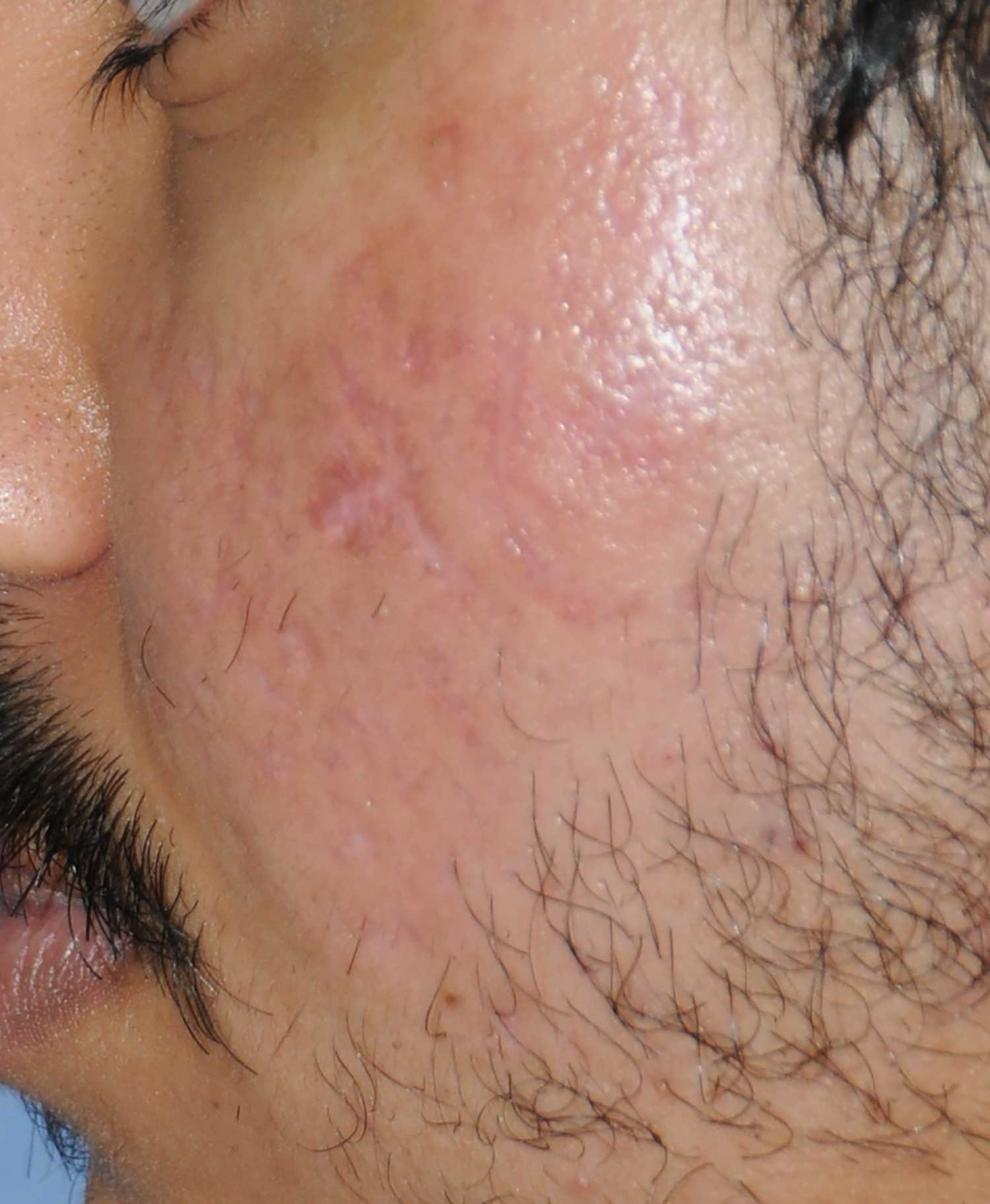 >Moderately Dark Skin Toned Patient Acne Scar Vitalizer Treatment Before Images of the Left Cheeks and Temples Profile Close Up View >Moderately Dark Skin Toned Patient Acne Scar Vitalizer Treatment Before Images of the Left Cheeks and Temples Profile Close Up View