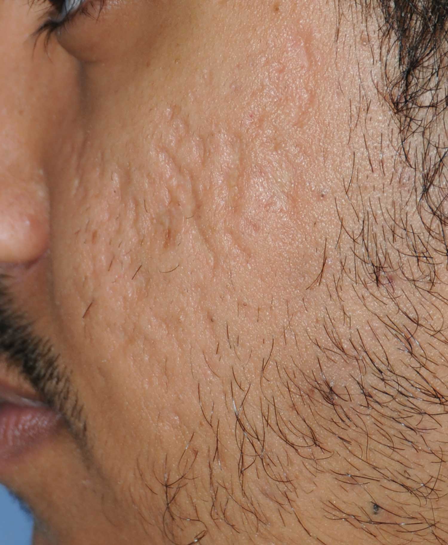 Moderately Dark Skin Toned Patient Acne Scar Vitalizer Treatment Before Images of the Left Cheeks and Temples Profile Close Up View Moderately Dark Skin Toned Patient Acne Scar Vitalizer Treatment Before Images of the Left Cheeks and Temples Profile Close Up View