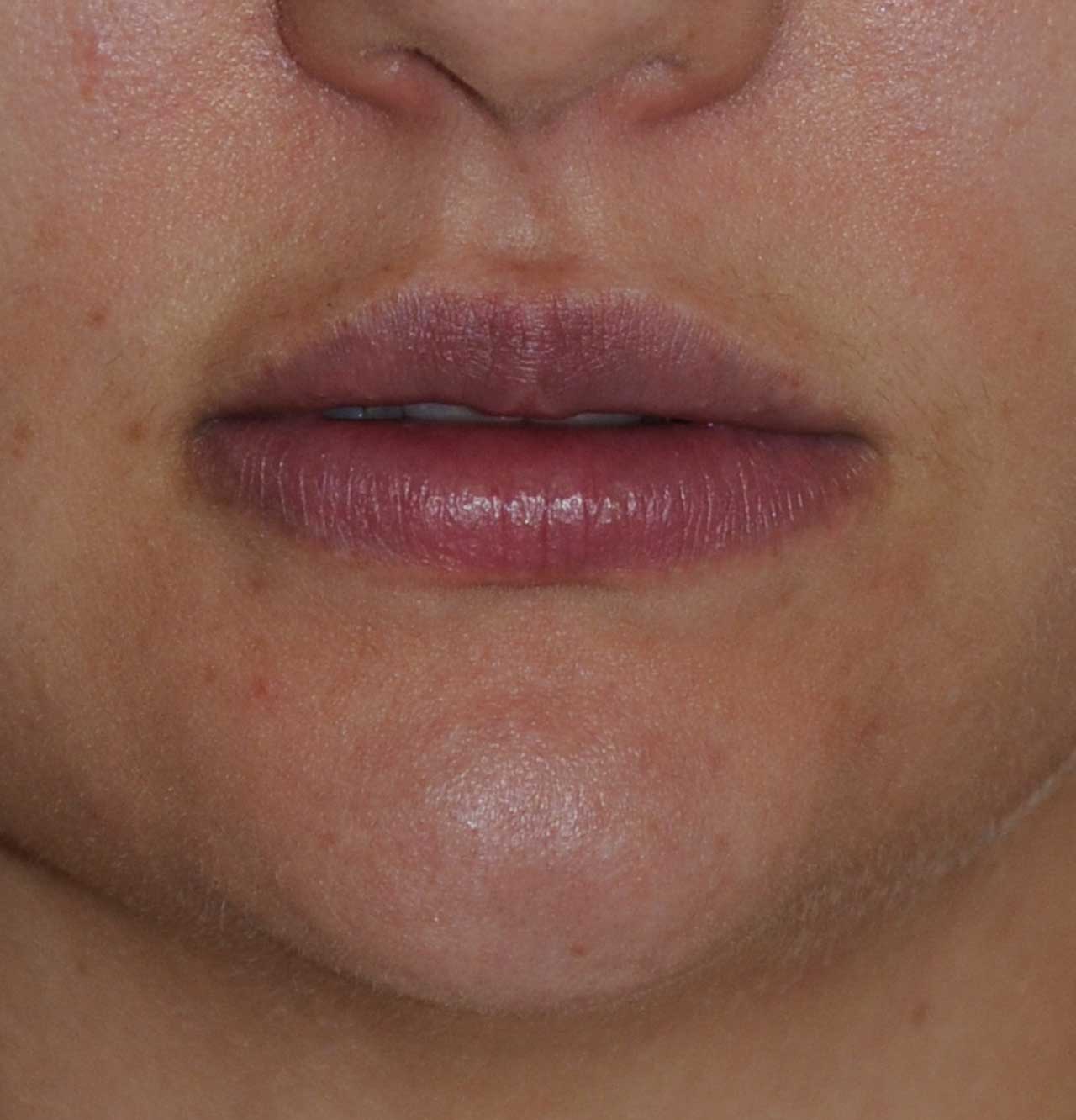 After Silicone Permalip Implants for small, thin lips