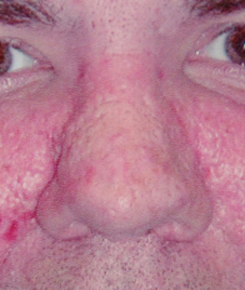 After Rhinophyma Rhinoplasty Treatment for Nose Lesions, Growths After Rhinophyma Rhinoplasty Treatment for Nose Lesions, Growths