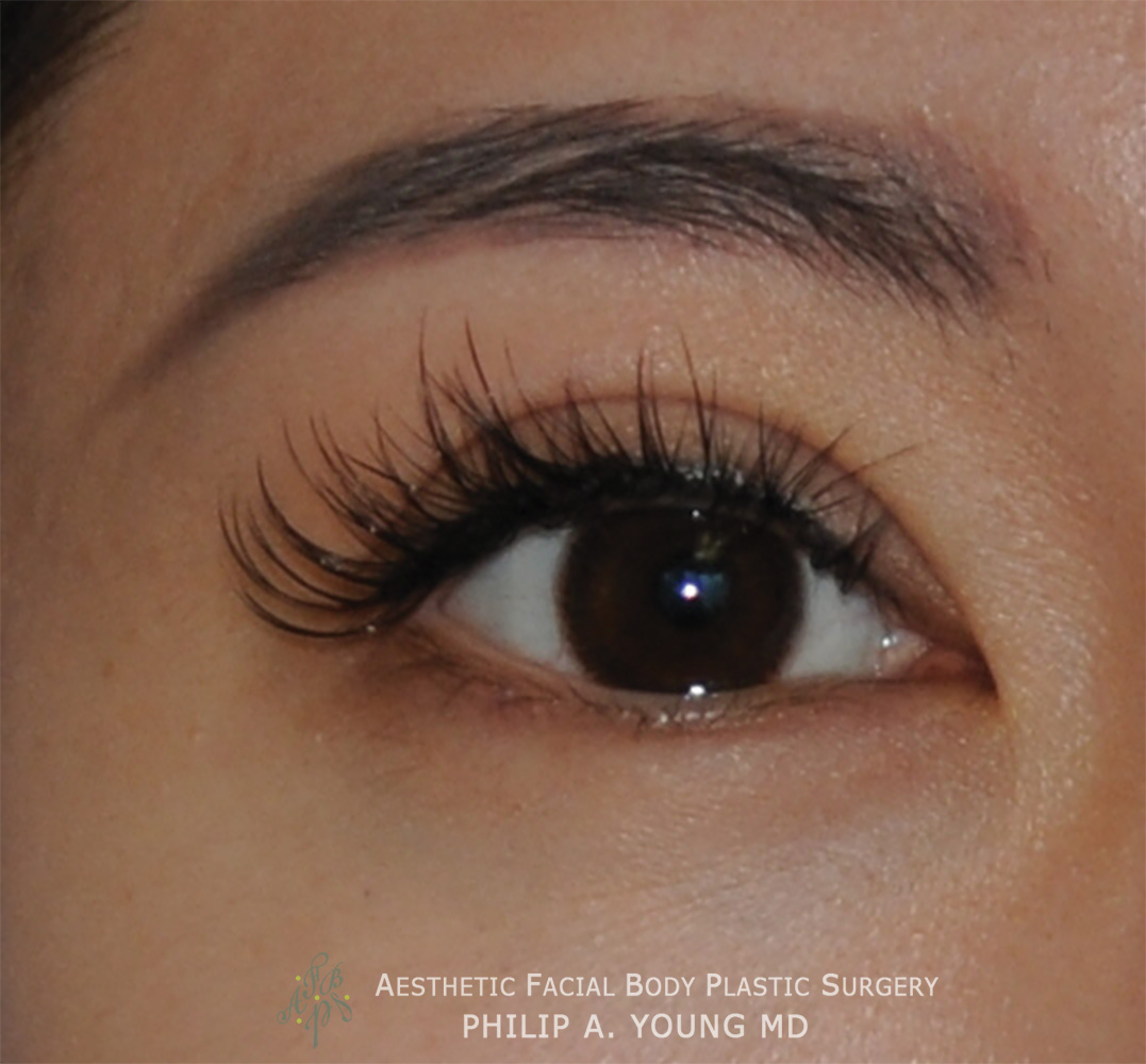After Double Eyelid Crease Formation