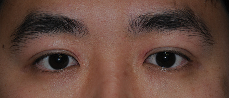 After Asian Double Eyelid Crease Formation Procedure for this Asian 20 Something Male from Eastern Washington After Asian Double Eyelid Crease Formation Procedure for this Asian 20 Something Male from Eastern Washington