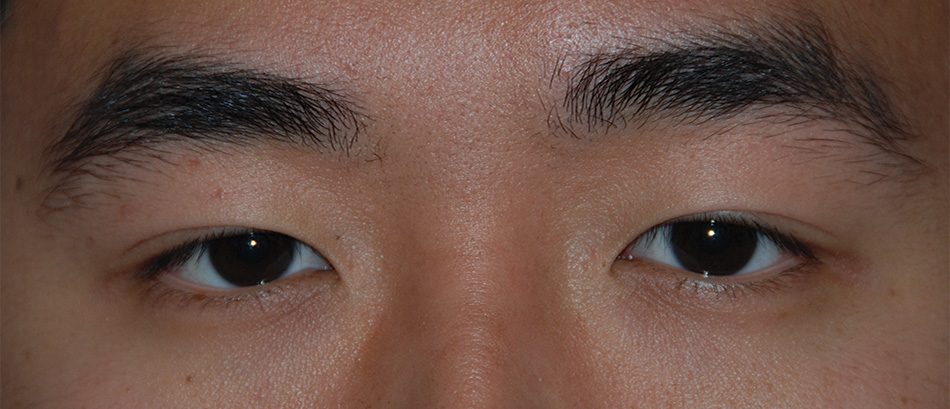 Before Asian Double Eyelid Crease Formation Procedure for this Asian 20 Something Male from Eastern Washington Before Asian Double Eyelid Crease Formation Procedure for this Asian 20 Something Male from Eastern Washington
