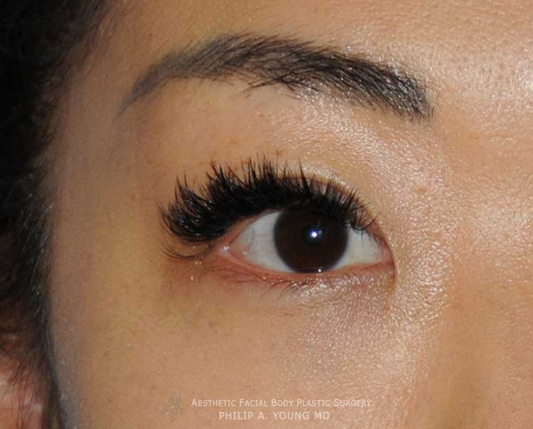 Approximately One Year After Asian Double Eyelid Crease Formation Surgery Close Up of the Right Eye Approximately One Year After Asian Double Eyelid Crease Formation Surgery Close Up of the Right Eye