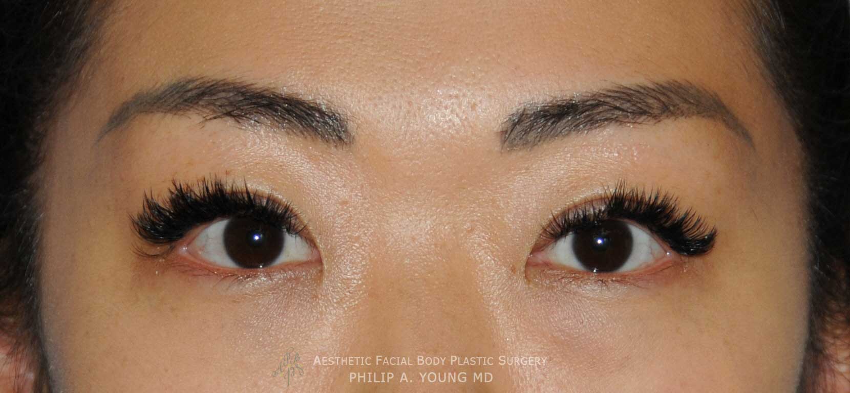 Approximately One Year After Asian Double Eyelid Crease Formation Surgery Close Up Approximately One Year After Asian Double Eyelid Crease Formation Surgery Close Up