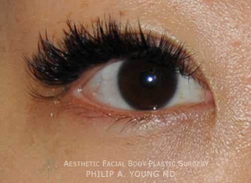 Approximately One Year After Asian Double Eyelid Crease Formation Surgery Extreme Close Up of the Right Eye Approximately One Year After Asian Double Eyelid Crease Formation Surgery Extreme Close Up of the Right Eye