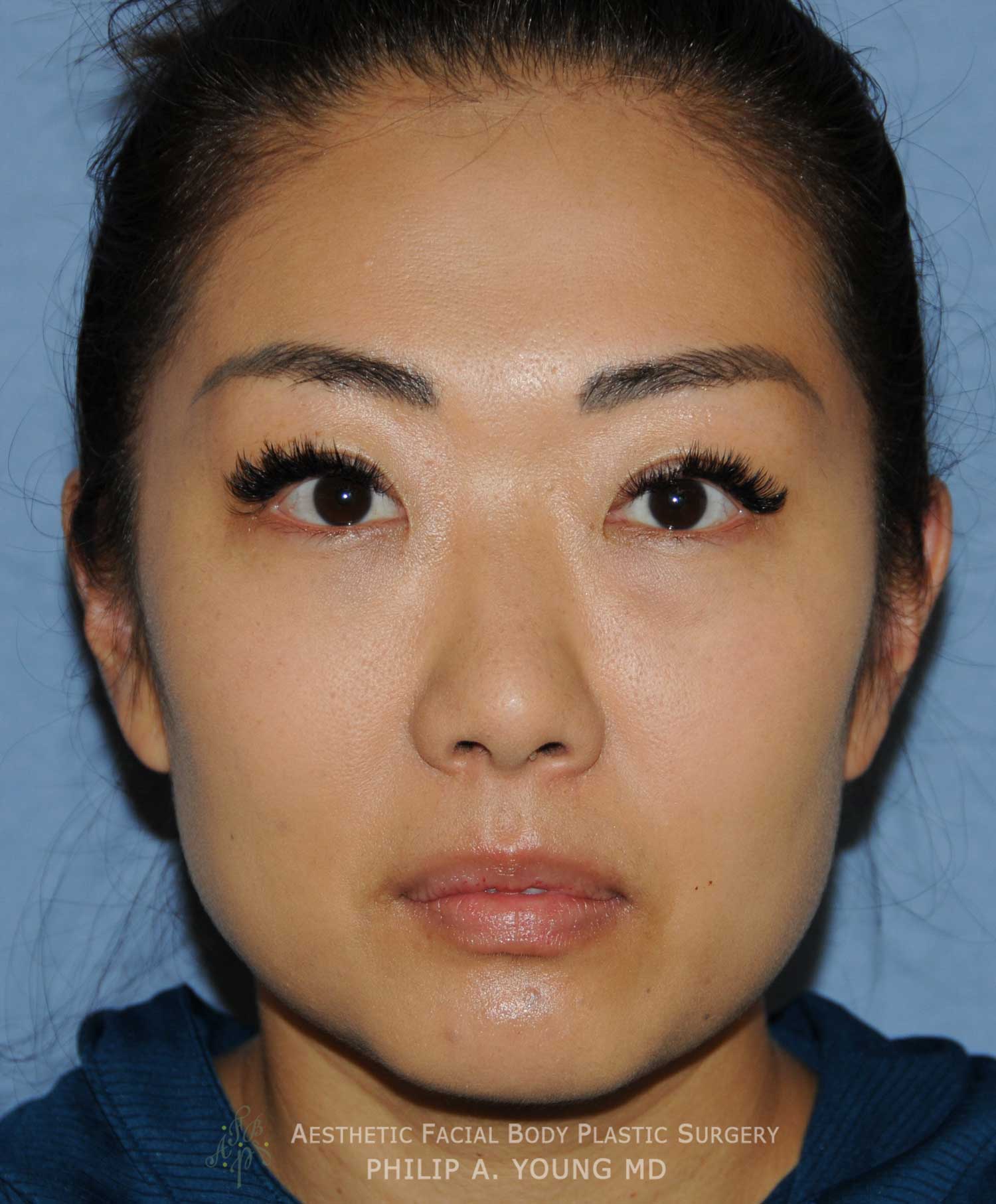After Asian Double Eyelid Crease Formation Surgery After Asian Double Eyelid Crease Formation Surgery 1 year after