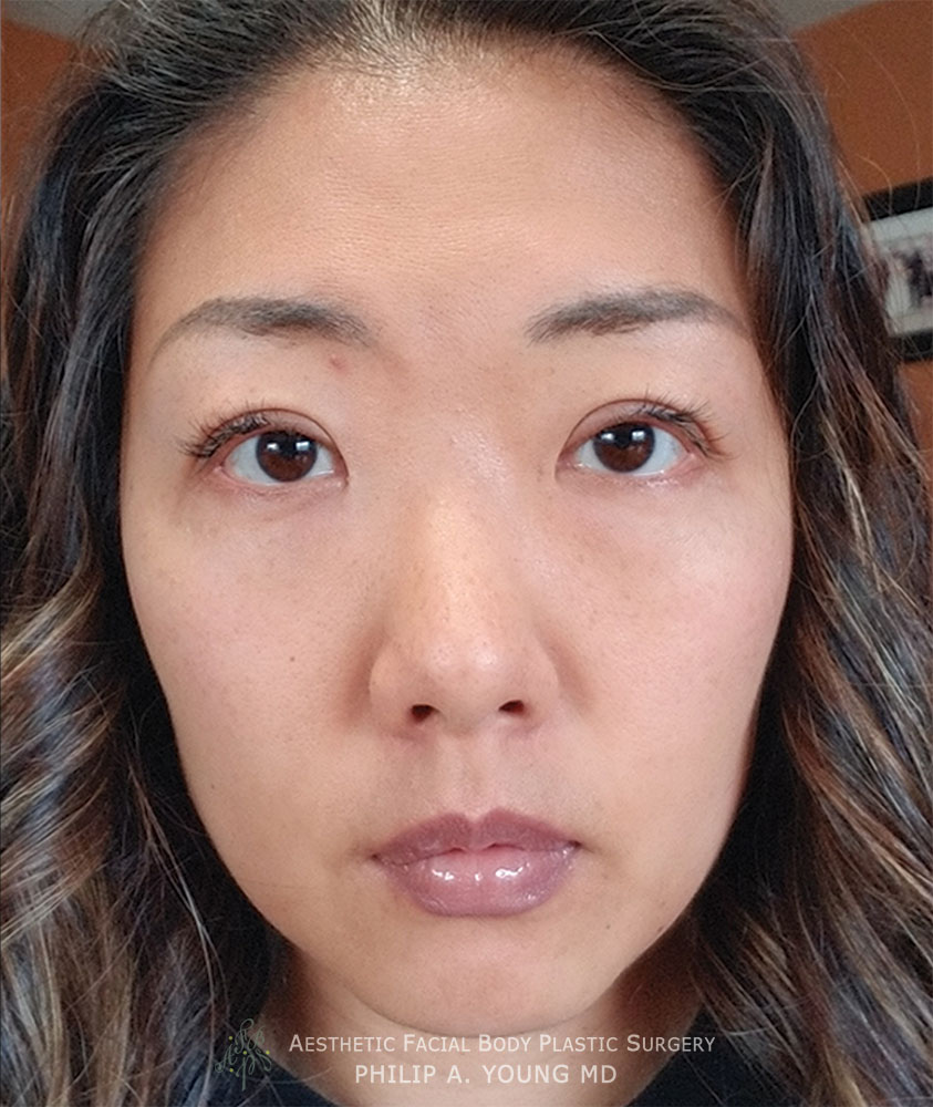 After Asian Double Eyelid Crease Formation Surgery After Asian Double Eyelid Crease Formation Surgery