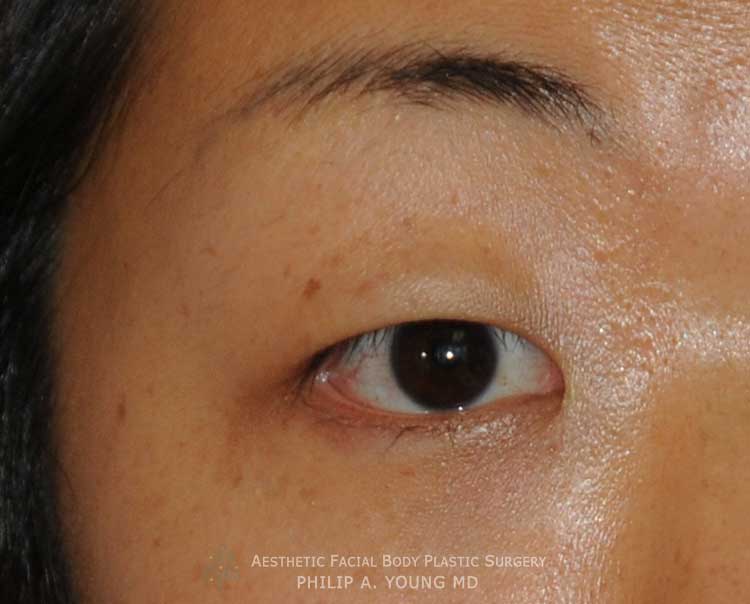Before Asian Double Eyelid Crease Formation Surgery Close Up of the Right Eye Before Asian Double Eyelid Crease Formation Surgery Close Up of the Right Eye