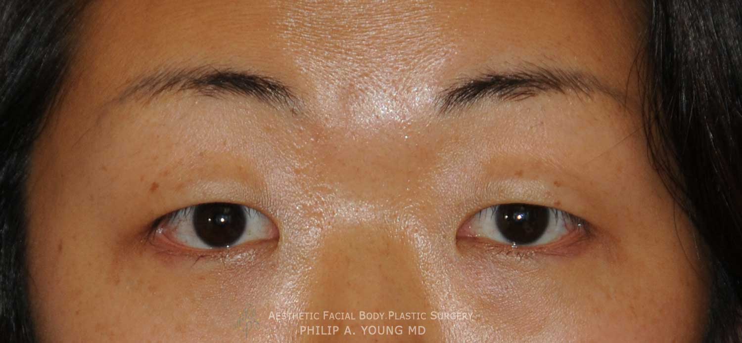 Before Asian Double Eyelid Crease Formation Surgery Before Asian Double Eyelid Crease Formation Surgery