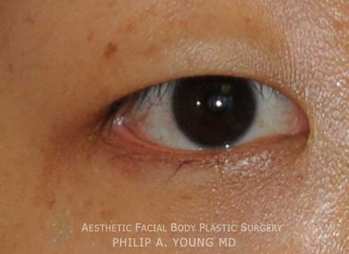 Before Asian Double Eyelid Crease Formation Surgery Extreme Close Up of the Right Eye Before Asian Double Eyelid Crease Formation Surgery Extreme Close Up of the Right Eye