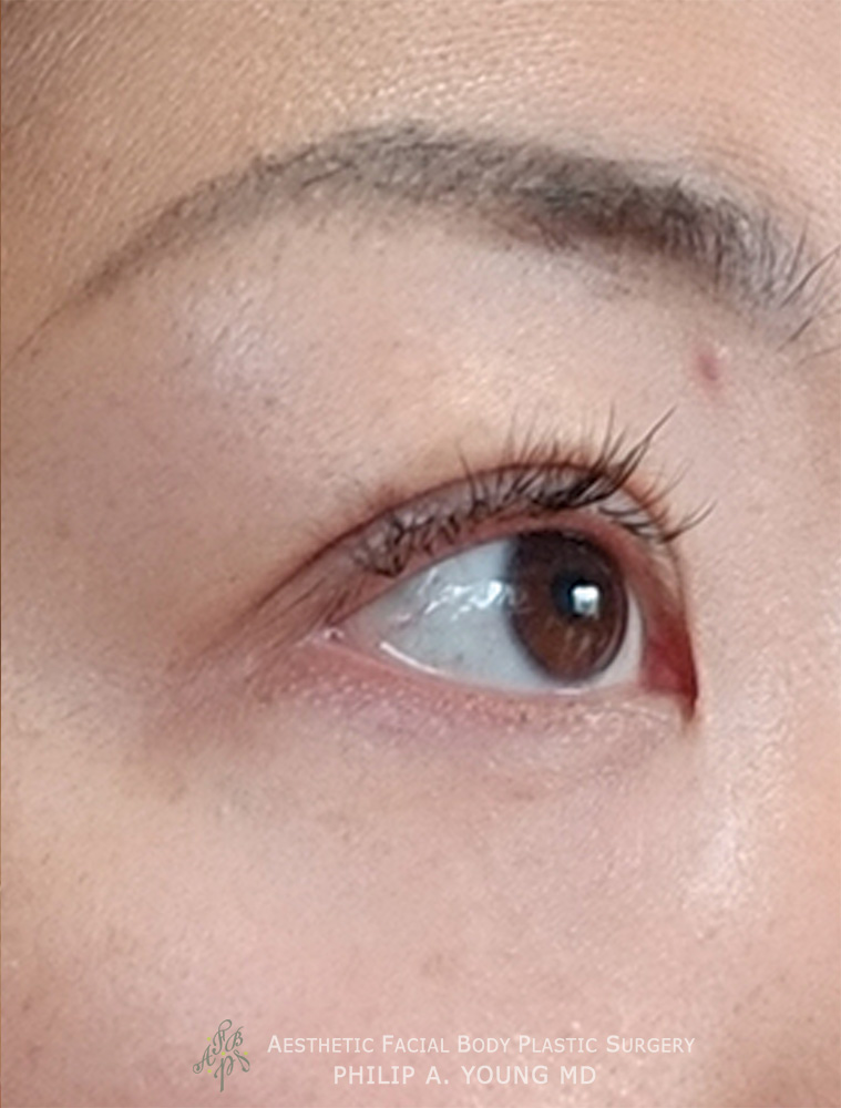 After Asian Double Eyelid Crease Formation Surgery Right Oblique View Close Up After Asian Double Eyelid Crease Formation Surgery Right Oblique View Close Up