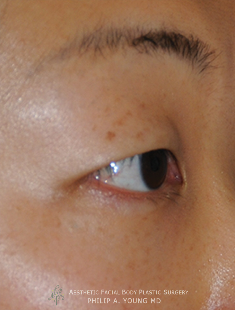 Before Asian Double Eyelid Crease Formation Surgery Right Oblique View Close Up Before Asian Double Eyelid Crease Formation Surgery Right Oblique View Close Up
