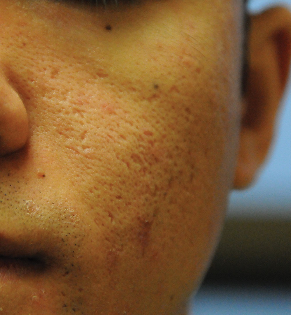 Before Acne Scar Vitalizer Laser Treatment for Ice Pick, Box Car Scars of the Left Cheek 20's Asian Male 4 months after Procedure Before Acne Scar Vitalizer Laser Treatment for Ice Pick, Box Car Scars of the Left Cheek 20's Asian Male 4 months after Procedure