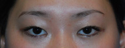 Asian Plastic Surgery Eyelid Before Asian Plastic Surgery Eyelid Before
