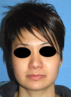 Asian Plastic Surgery Rhinoplasty After Asian Plastic Surgery Rhinoplasty After