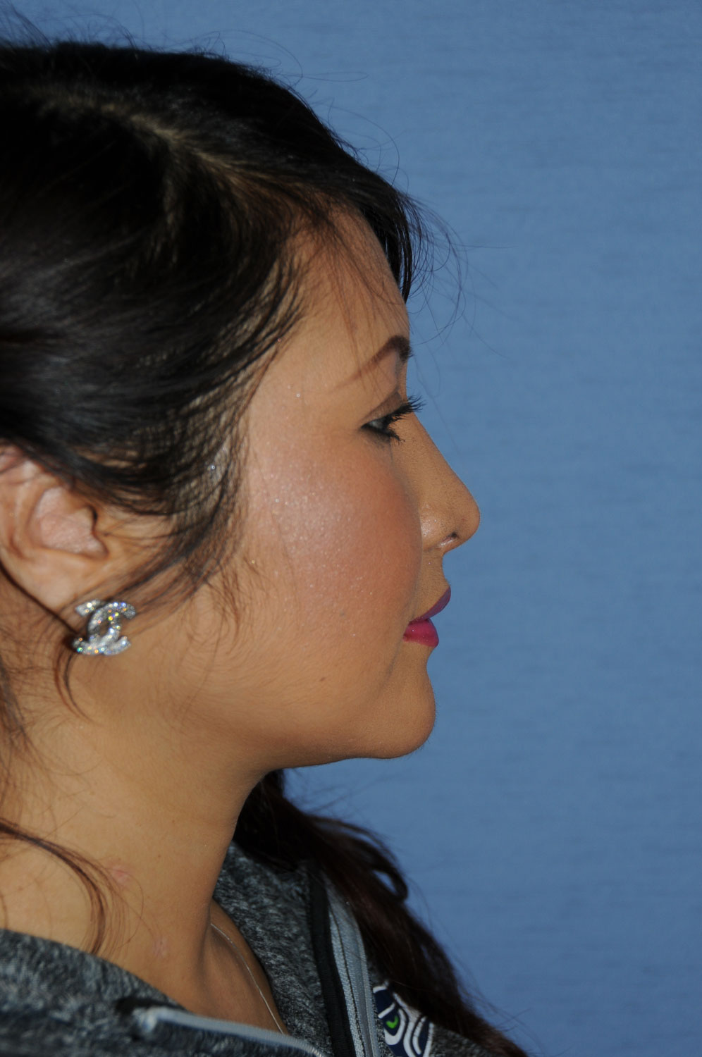 Right Side View After Asian Rhinoplasty to Raise the Tip and Nasal Bridge with all Ear Cartilage Using Temporalis Fascia and Ear cartilage for the Bridge and Tip Grafting for the Nose Right Side View After Asian Rhinoplasty to Raise the Tip and Nasal Bridge with all Ear Cartilage Using Temporalis Fascia and Ear cartilage for the Bridge and Tip Grafting for the Nose