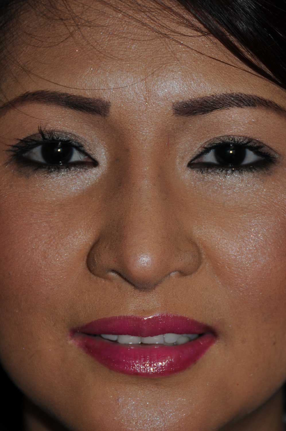 After Asian Rhinoplasty to Raise the Tip and Nasal Bridge with all Ear Cartilage Using Temporalis Fascia and Ear cartilage for the Bridge and Tip Grafting for the Nose After Asian Rhinoplasty to Raise the Tip and Nasal Bridge with all Ear Cartilage Using Temporalis Fascia and Ear cartilage for the Bridge and Tip Grafting for the Nose