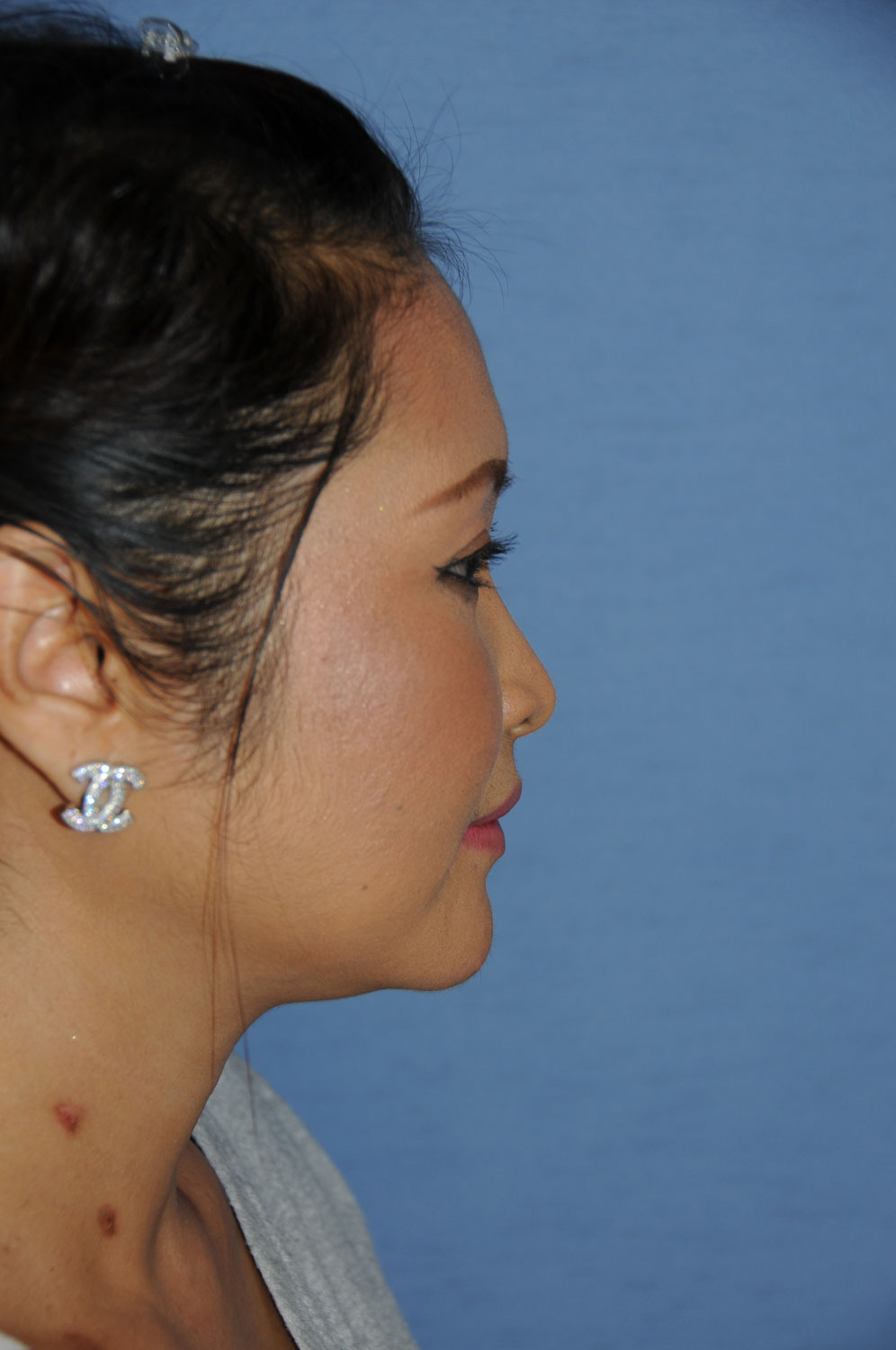 Right Side ViewBefore Asian Rhinoplasty to Raise the Tip and Nasal Bridge with all Ear Cartilage Using Temporalis Fascia and Ear cartilage for the Bridge and Tip Grafting for the Nose Right Side View Before Asian Rhinoplasty to Raise the Tip and Nasal Bridge with all Ear Cartilage Using Temporalis Fascia and Ear cartilage for the Bridge and Tip Grafting for the Nose