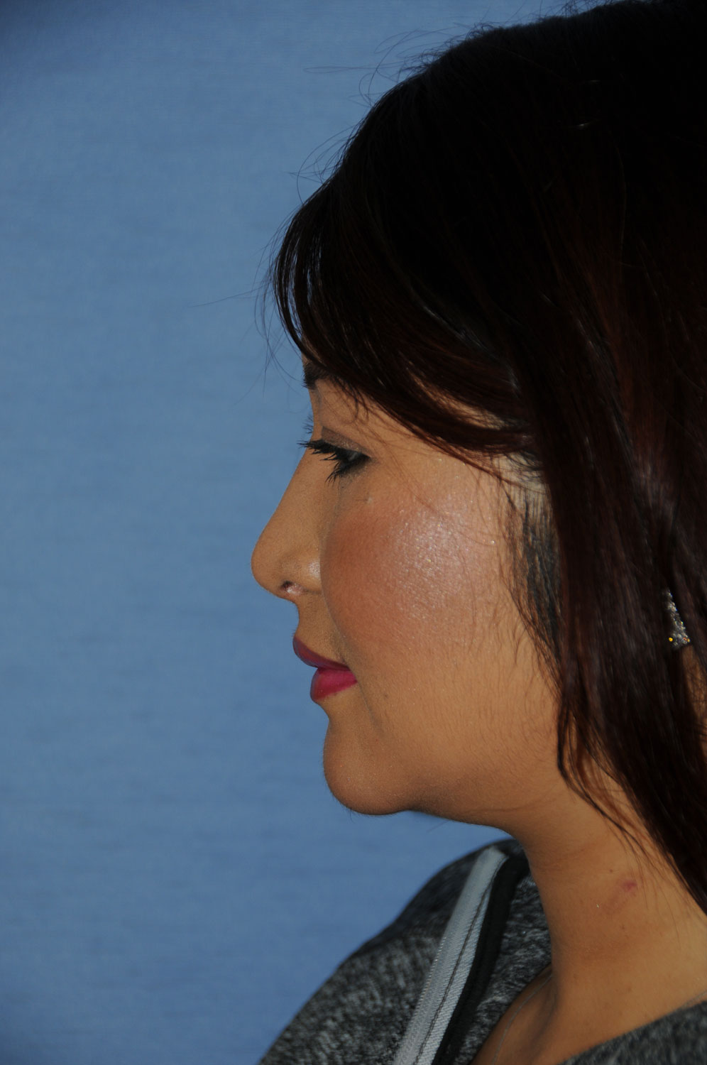 Side View After Asian Rhinoplasty to Raise the Tip and Nasal Bridge with all Ear Cartilage Using Temporalis Fascia and Ear cartilage for the Bridge and Tip Grafting for the Nose Side View After Asian Rhinoplasty to Raise the Tip and Nasal Bridge with all Ear Cartilage Using Temporalis Fascia and Ear cartilage for the Bridge and Tip Grafting for the Nose