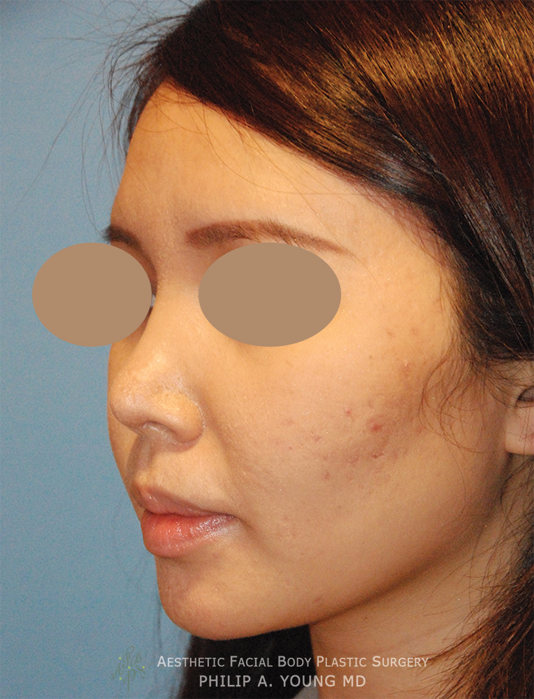 After Asian Rhinoplasty Frontal View Before and After Nasal Tip Refinement for Bulbous Tip Using Ear Cartilage, Temporalis Fascia for an Augmentation using Natural not Foreign Material Left Oblique View