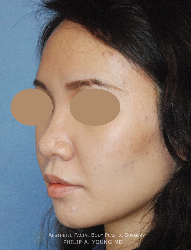 Before Asian Rhinoplasty Frontal View Before and After Nasal Tip Refinement for Bulbous Tip Using Ear Cartilage, Temporalis Fascia for an Augmentation using Natural not Foreign Material Left Oblique View