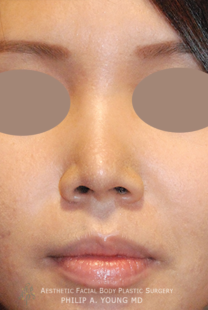 After Asian Rhinoplasty Frontal View Before and After Nasal Tip Refinement for Bulbous Tip Using Ear Cartilage, Temporalis Fascia for an Augmentation using Natural not Foreign Material
