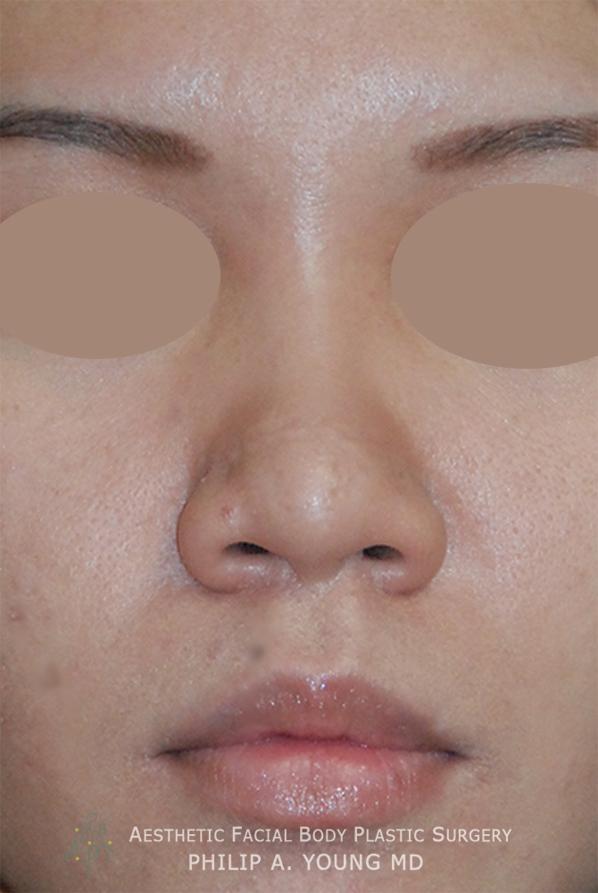 Before Asian Rhinoplasty Frontal View Before and After Nasal Tip Refinement for Bulbous Tip Using Ear Cartilage, Temporalis Fascia for an Augmentation using Natural not Foreign Material