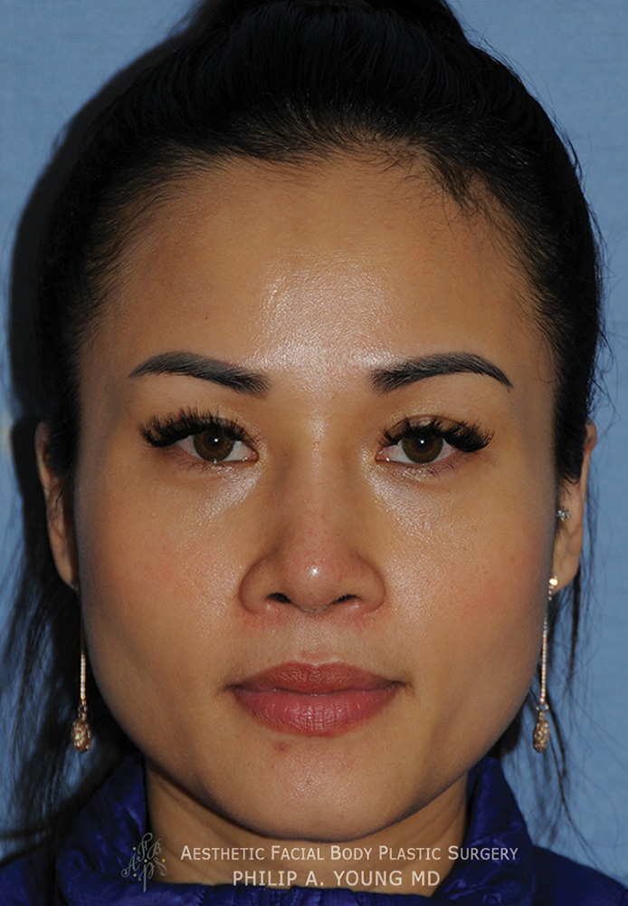 Asian Rhinoplasty with Silicone Implant for Flat Wide Nose After Front View Asian Rhinoplasty with Silicone Implant for Flat Wide Nose After Front View
