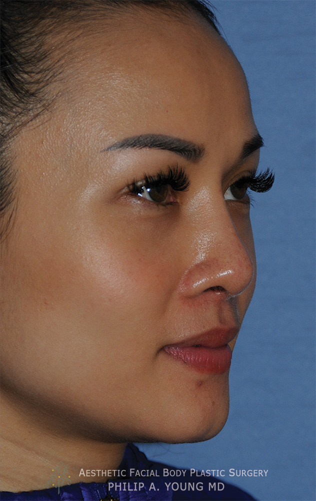 Asian Rhinoplasty with Silicone Implant for Flat Wide Nose After Oblique View Asian Rhinoplasty with Silicone Implant for Flat Wide Nose After Oblique View