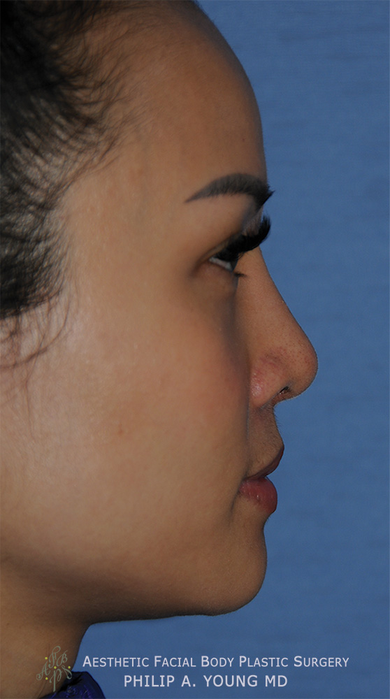 Asian Rhinoplasty with Silicone Implant for Flat Wide Nose After Side View Asian Rhinoplasty with Silicone Implant for Flat Wide Nose After Side View